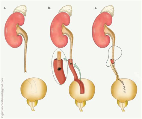 adam marcheluk|Reconstructive surgery of the extensive ureter strictures using。